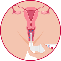 Applikator einführen