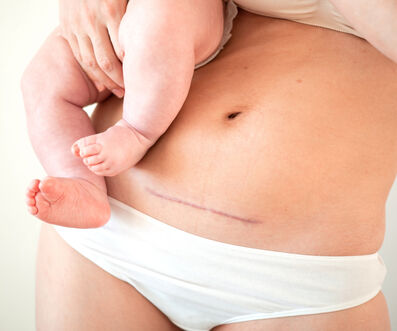 April ist der Kaiserschnitt Awareness Monat