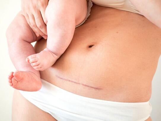 Reducing Surgical Site Infection in Caesarean Sections