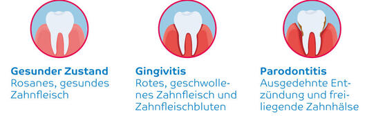 Bildliche Darstellung der Zahnfleischerkrankungen Gingivitis und Parodontitis