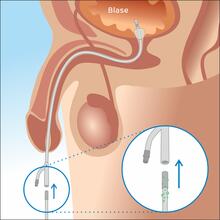 Illustration of the development of a catheter-associated urinary tract infection due to undesirable pathogens inside the indwelling catheter.