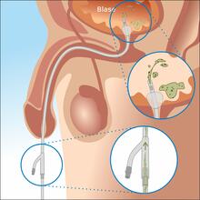 Illustration of the development of a catheter-associated urinary tract infection due to urine reflux