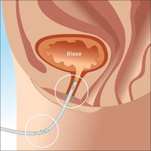 Illustration of the development of a catheter-associated urinary tract infection due to contaminated catheter materials.