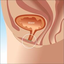Illustration of the development of a catheter-associated urinary tract infection by flora colonised in the genital area.