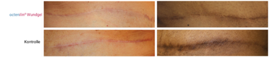 Beispiel der Narbenbildung mit octenidinhaltigem Wundgel