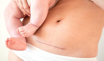 Reducing Surgical Site Infecton in Cesarean Sections