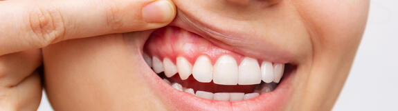 Octenidin in der Mundhöhle