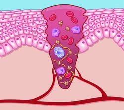 Reinigungsphase (Exsudation)